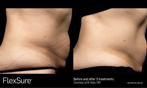 Flexsure Treatment - 3 Treatments before and after